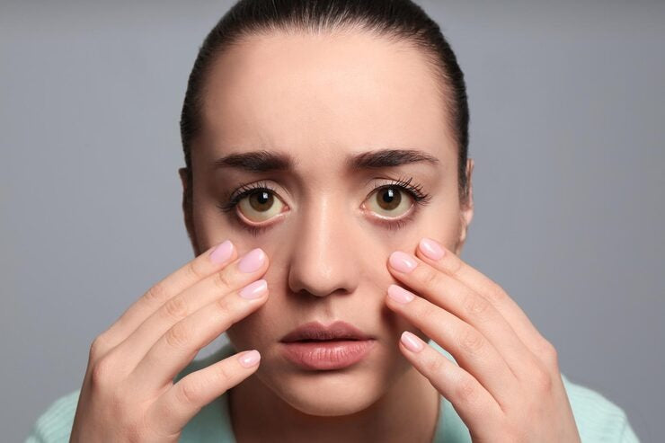 Why Do Dark Circles Form Under the Eyes?
